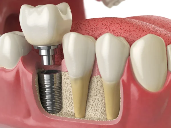 Rethinking Dental Implant Aftercare for Optimal Results