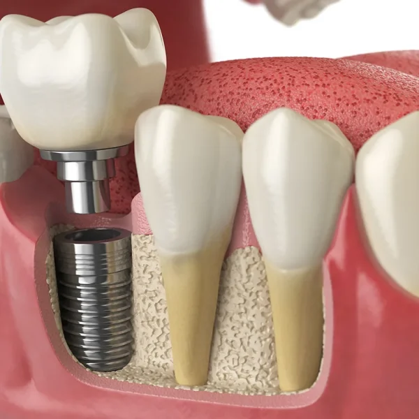 Rethinking Dental Implant Aftercare for Optimal Results