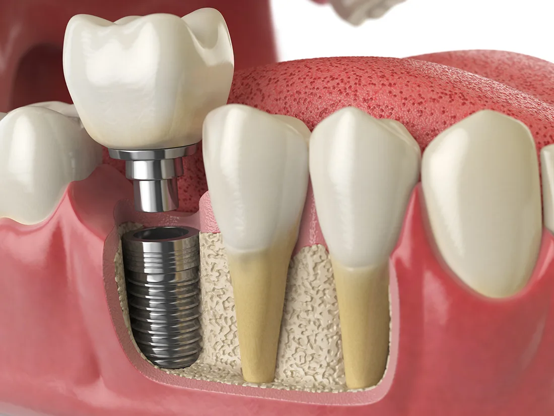 Rethinking Dental Implant Aftercare for Optimal Results